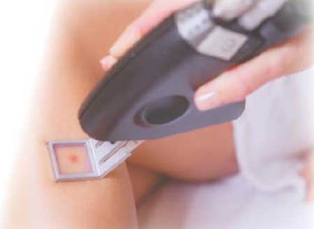 激光衍射元件DOE在激光醫美行業的應用